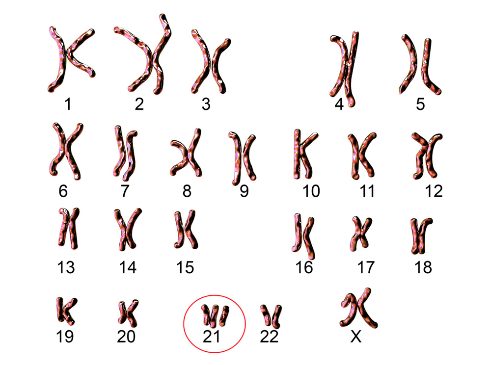 cromosoma 21